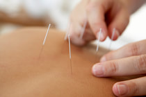 Acupuncture for back and knee pain Physio Leichhardt